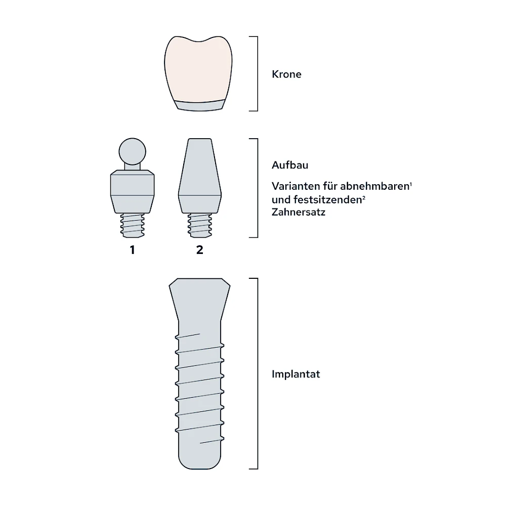Implantate: Bestandteile