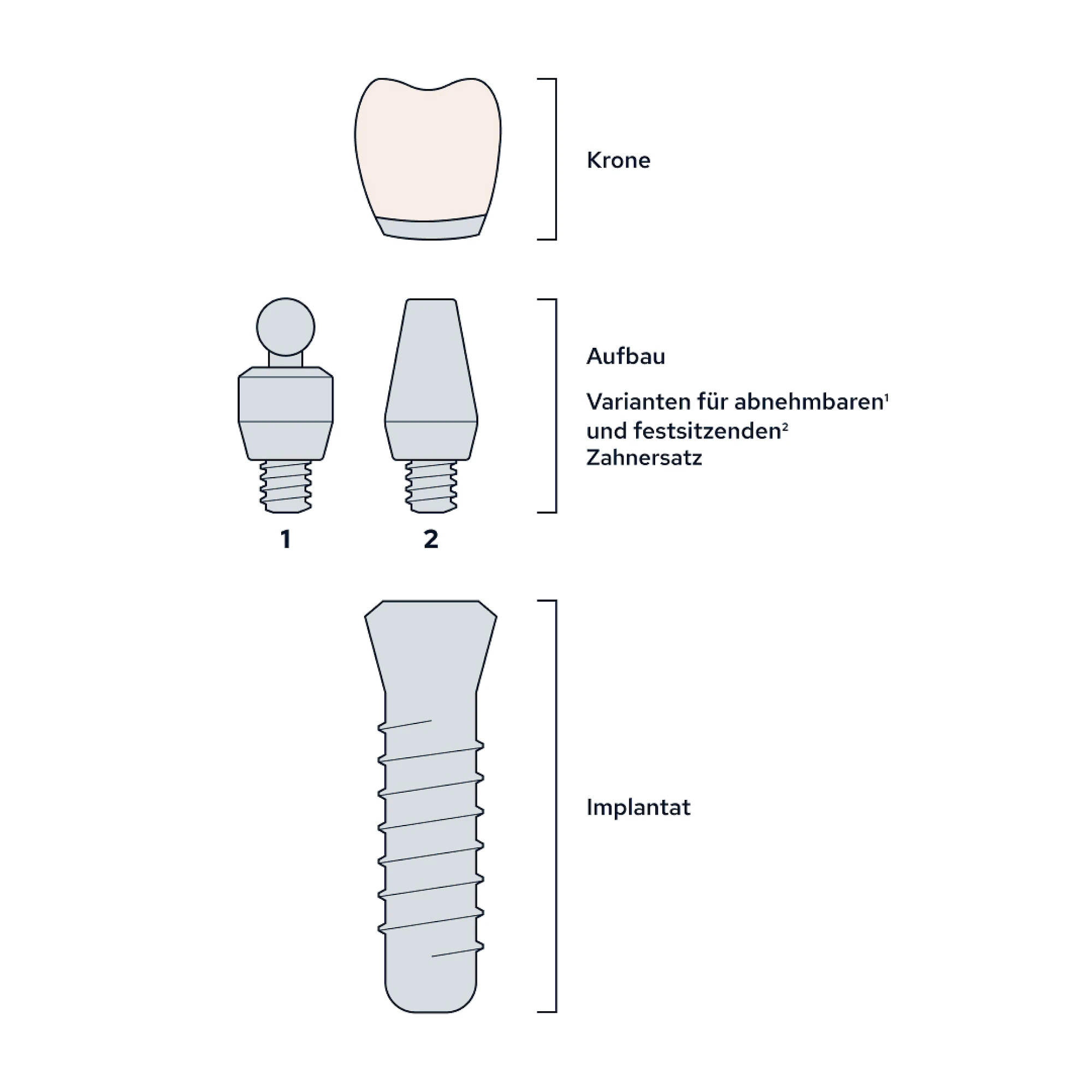 Implantate: Bestandteile