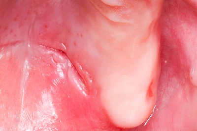 Beispiele: Druckstelle / Lappenfibrom