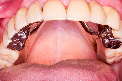 Beispiele: Druckstelle / Lappenfibrom