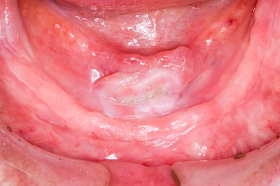 Beispiele: Druckstelle / Lappenfibrom