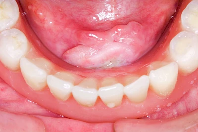 Beispiele: Druckstelle / Lappenfibrom