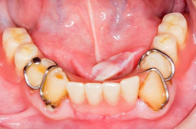 Beispiele: Druckstelle / Lappenfibrom