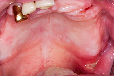 Beispiele: Druckstelle / Lappenfibrom