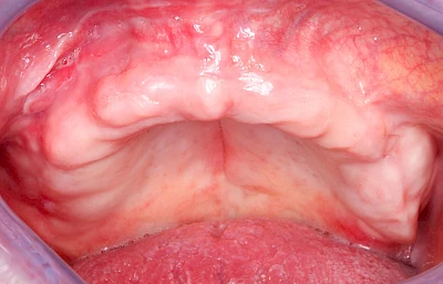 Beispiele: Druckstelle / Lappenfibrom