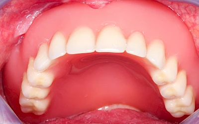 Beispiele: Druckstelle / Lappenfibrom