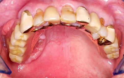 Beispiele: Druckstelle / Lappenfibrom