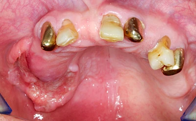 Beispiele: Druckstelle / Lappenfibrom