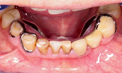 Beispiele: Druckstelle / Lappenfibrom