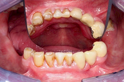 Beispiele: Druckstelle / Lappenfibrom
