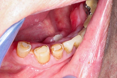 Beispiele: Druckstelle / Lappenfibrom