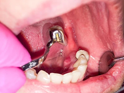 Beispiele: Druckstelle / Lappenfibrom