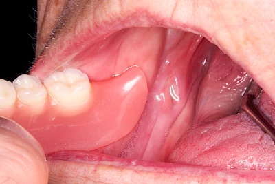 Beispiele: Druckstelle / Lappenfibrom