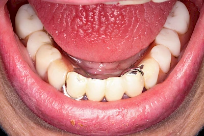 Beispiele: Druckstelle / Lappenfibrom