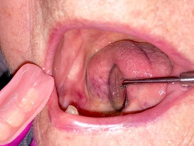 Beispiele: Druckstelle / Lappenfibrom
