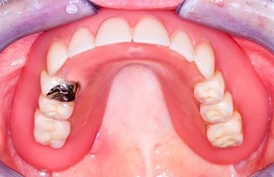 Beispiele: Druckstelle / Lappenfibrom