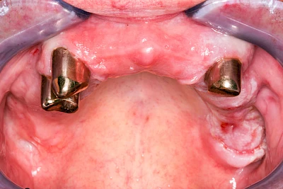 Beispiele: Druckstelle / Lappenfibrom