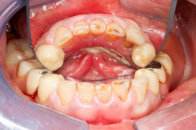 Beispiele: Druckstelle / Lappenfibrom