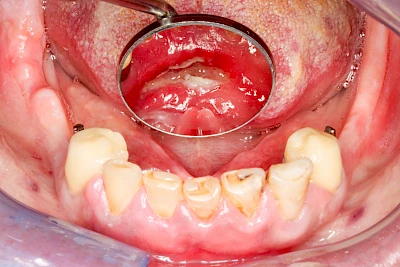 Beispiele: Druckstelle / Lappenfibrom