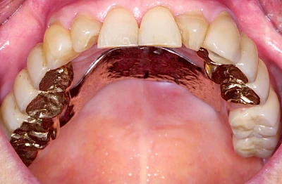 Beispiele: Druckstelle / Lappenfibrom
