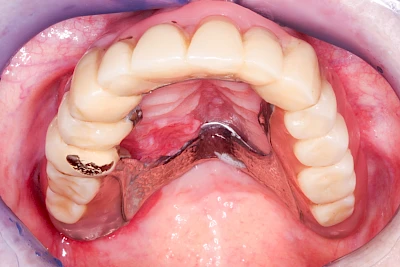 Beispiele: Druckstelle / Lappenfibrom