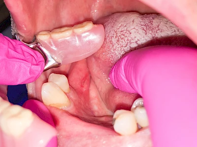 Beispiele: Druckstelle / Lappenfibrom