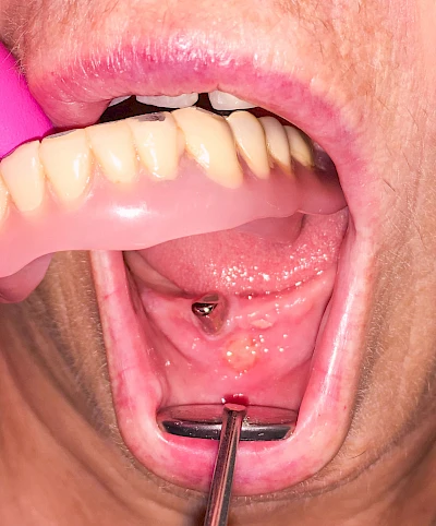 Beispiele: Druckstelle / Lappenfibrom