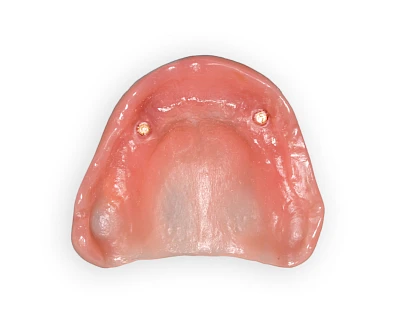 Beispiele: Prothesenstomatitis