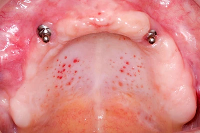 Beispiele: Prothesenstomatitis