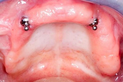 Beispiele: Prothesenstomatitis