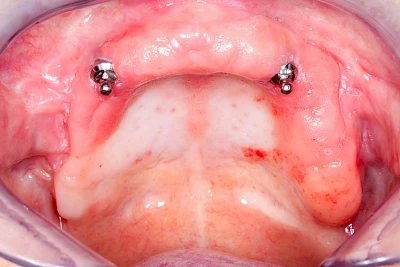Beispiele: Prothesenstomatitis