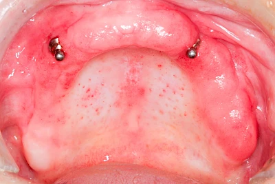 Beispiele: Prothesenstomatitis