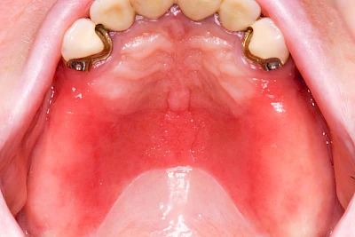 Beispiele: Prothesenstomatitis