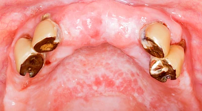 Beispiele: Prothesenstomatitis