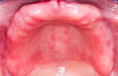 Beispiele: Prothesenstomatitis