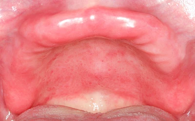 Beispiele: Prothesenstomatitis