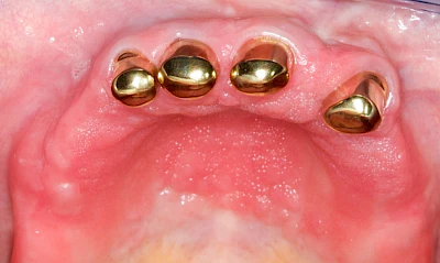 Beispiele: Prothesenstomatitis