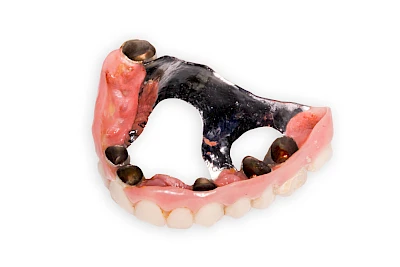 Beispiele: Prothesenstomatitis