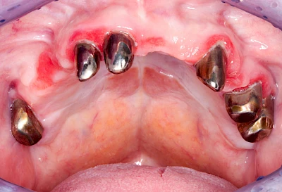 Beispiele: Prothesenstomatitis