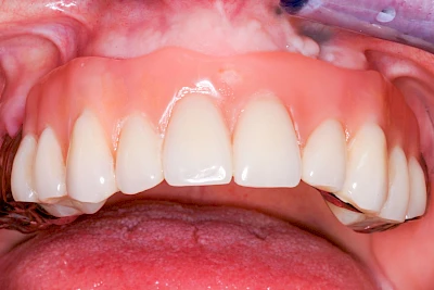 Beispiele: Prothesenstomatitis