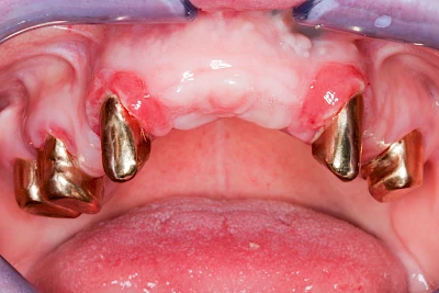 Beispiele: Prothesenstomatitis