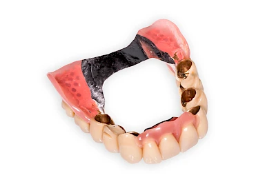 Beispiele: Prothesenstomatitis