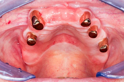 Beispiele: Prothesenstomatitis
