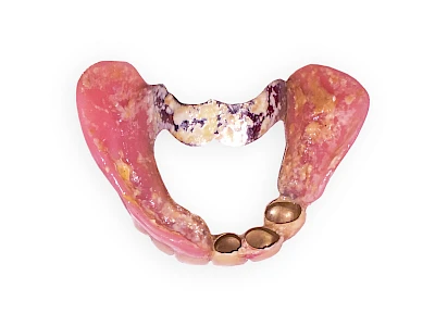 Beispiele: Prothesenstomatitis