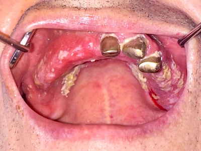 Beispiele: Prothesenstomatitis