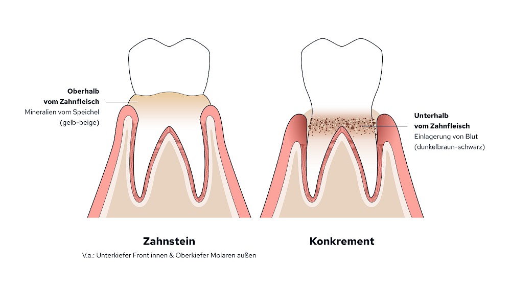 Unterscheidung von Zahnstein und Konkrement
