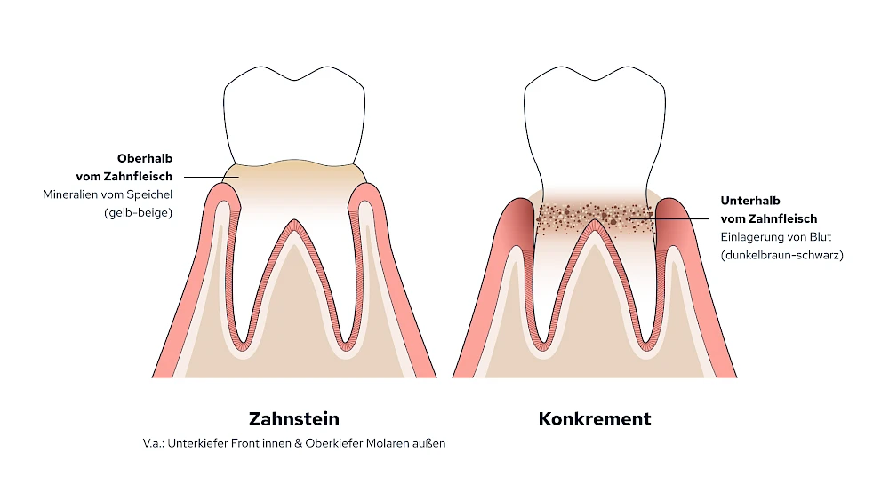 Unterscheidung von Zahnstein und Konkrement