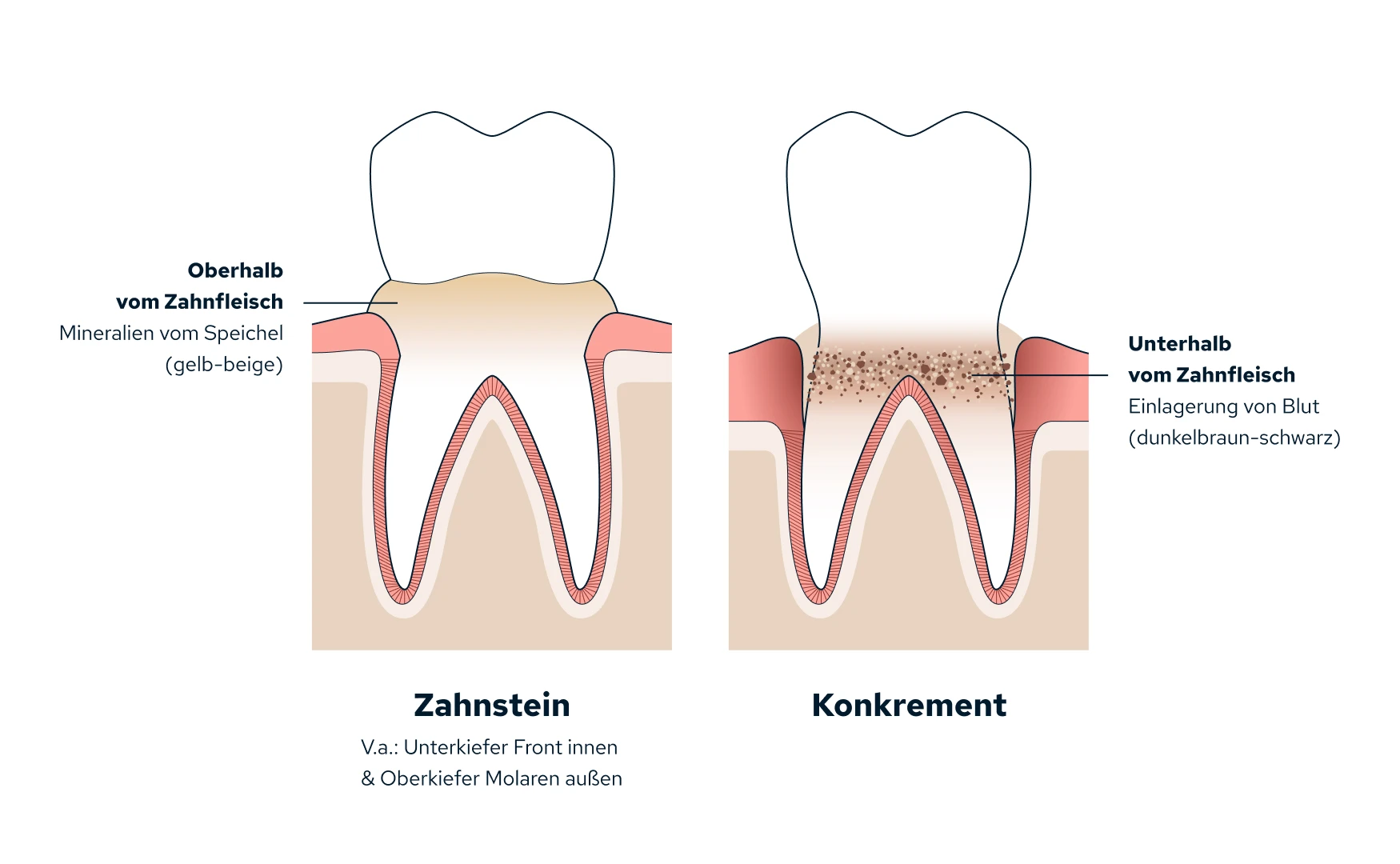 Unterscheidung von Zahnstein und Konkrement