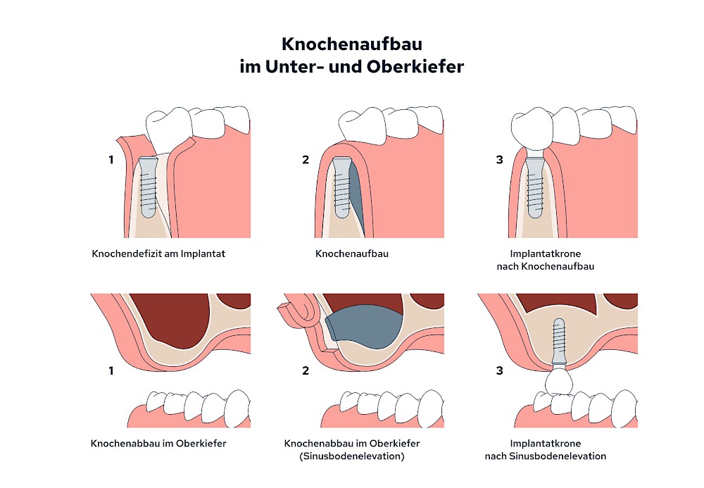 Knochenaufbau und Implantateinsatz