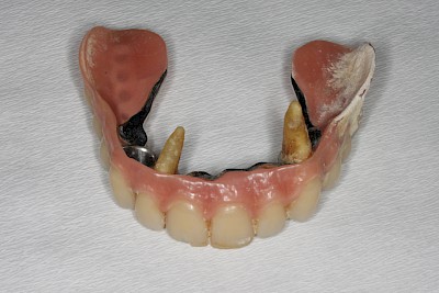 Beispiele für Verlust der Verankerung an Zähne bzw. Implantaten